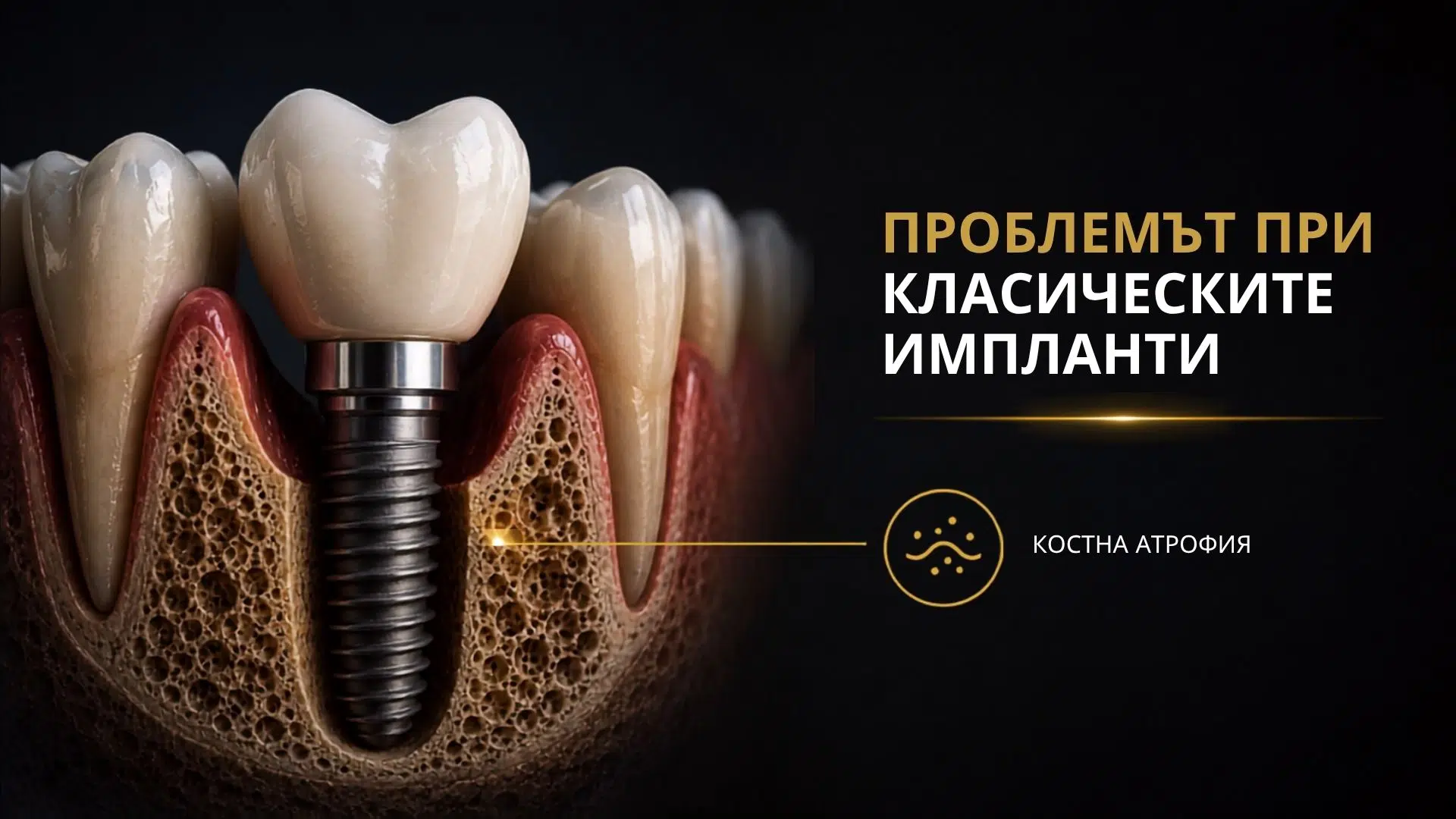 Базални импланти при пациент с костна атрофия